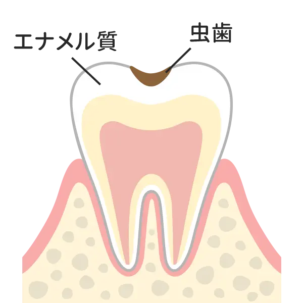 C1（エナメル質）