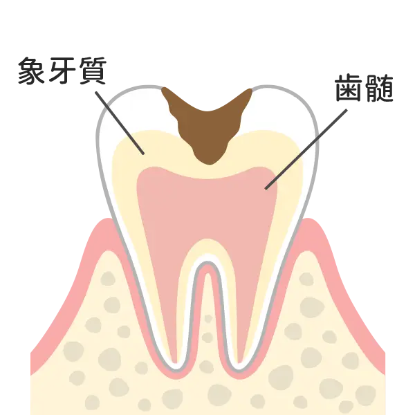 C2（象牙質）