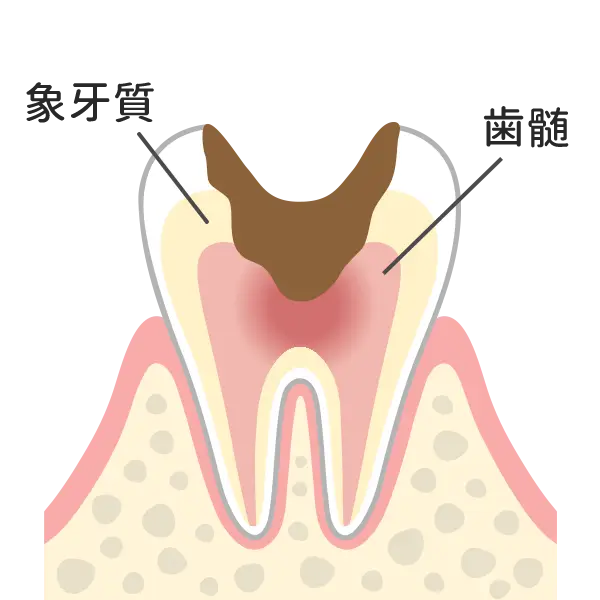C3（神経まで到達）