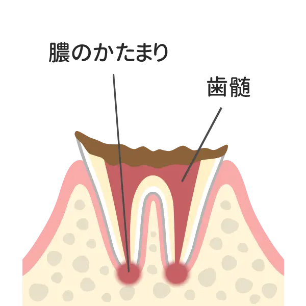 C4（歯の根まで到達）