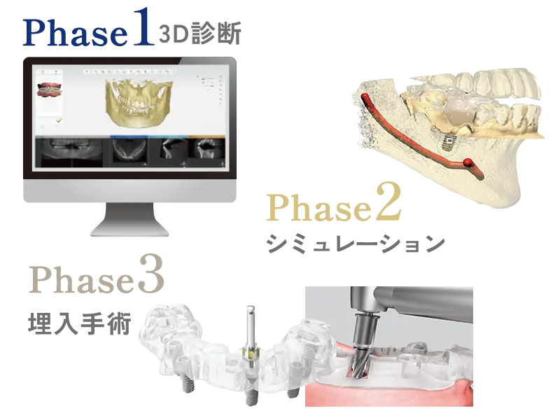 インプラントガイドシステム
