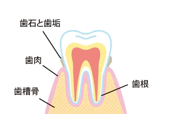 歯肉炎